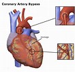 Coronary Bypass Surgery Illustration